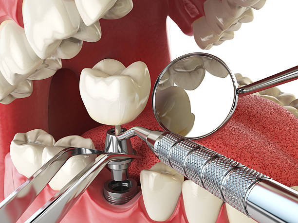 Best Emergency Wisdom Teeth Removal in Ravenna, NE
